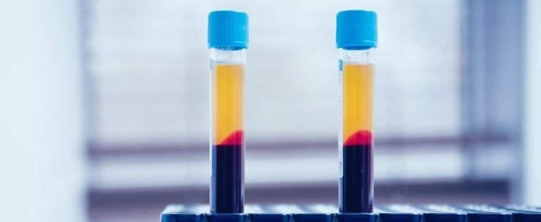 PRP injecties bij artrose
