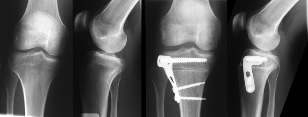Rontgenfoto Knie osteotomie